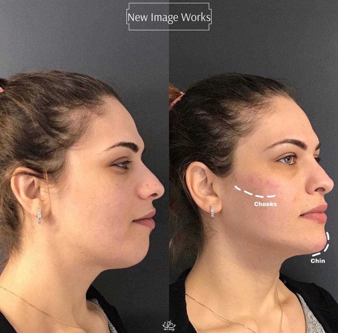 1 Juvederm + 1 Voluma