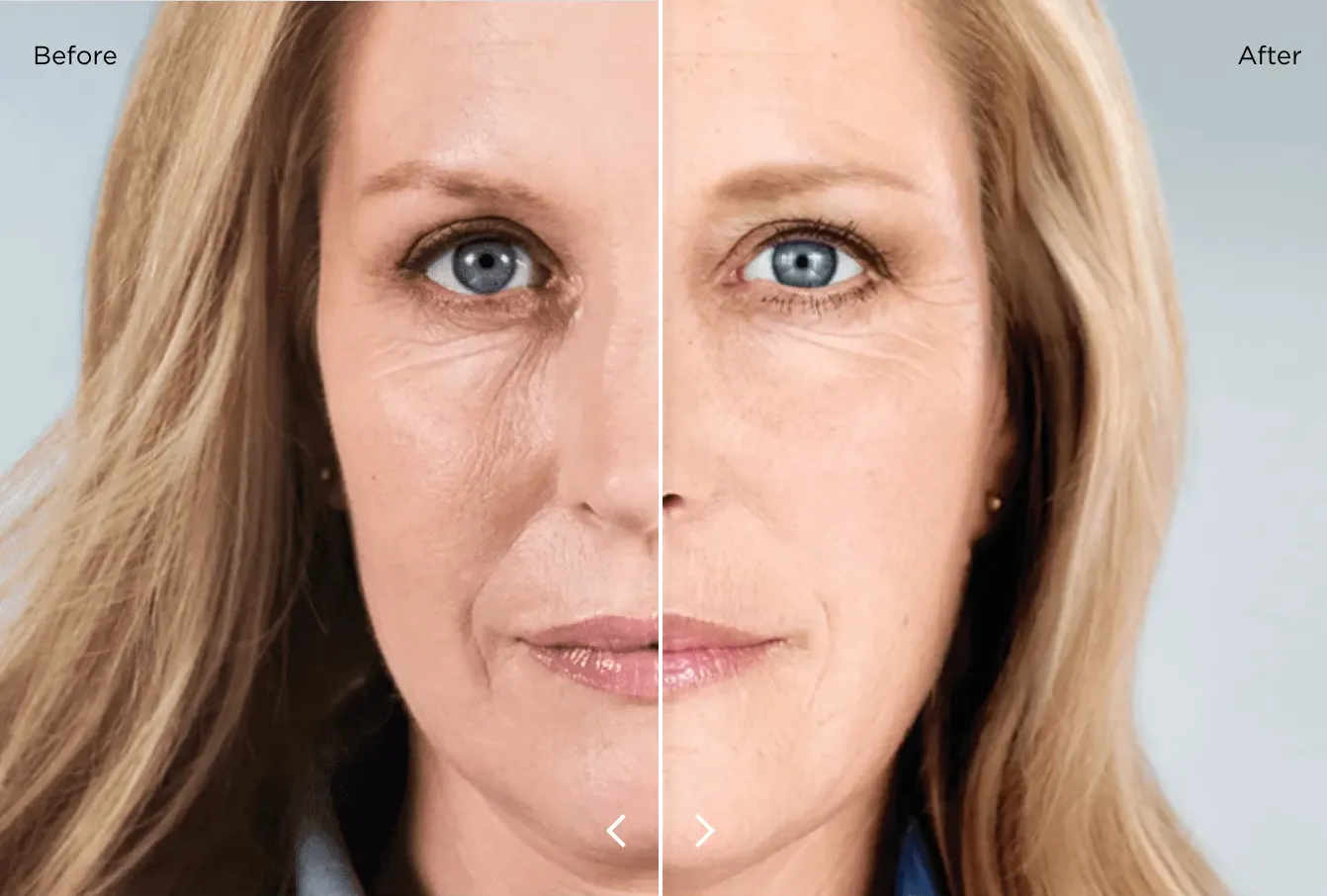 2 Sculptra Vials