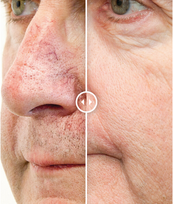 BBL Forever Young 3 Area (Face+Chest+Neck) 3 Sessions