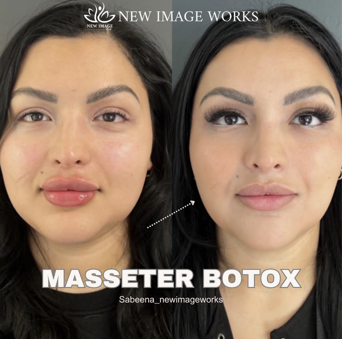 Masseter Botox