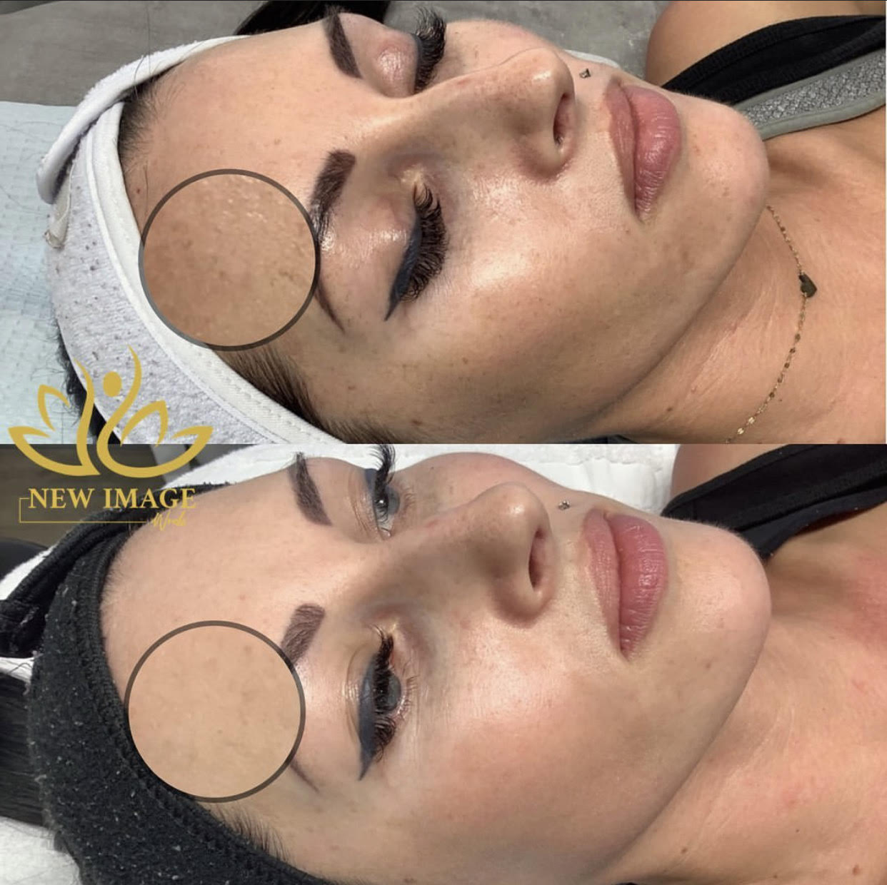 Resurface Me (3 Microneedling with PRP injections + 3 Dermaplanning)