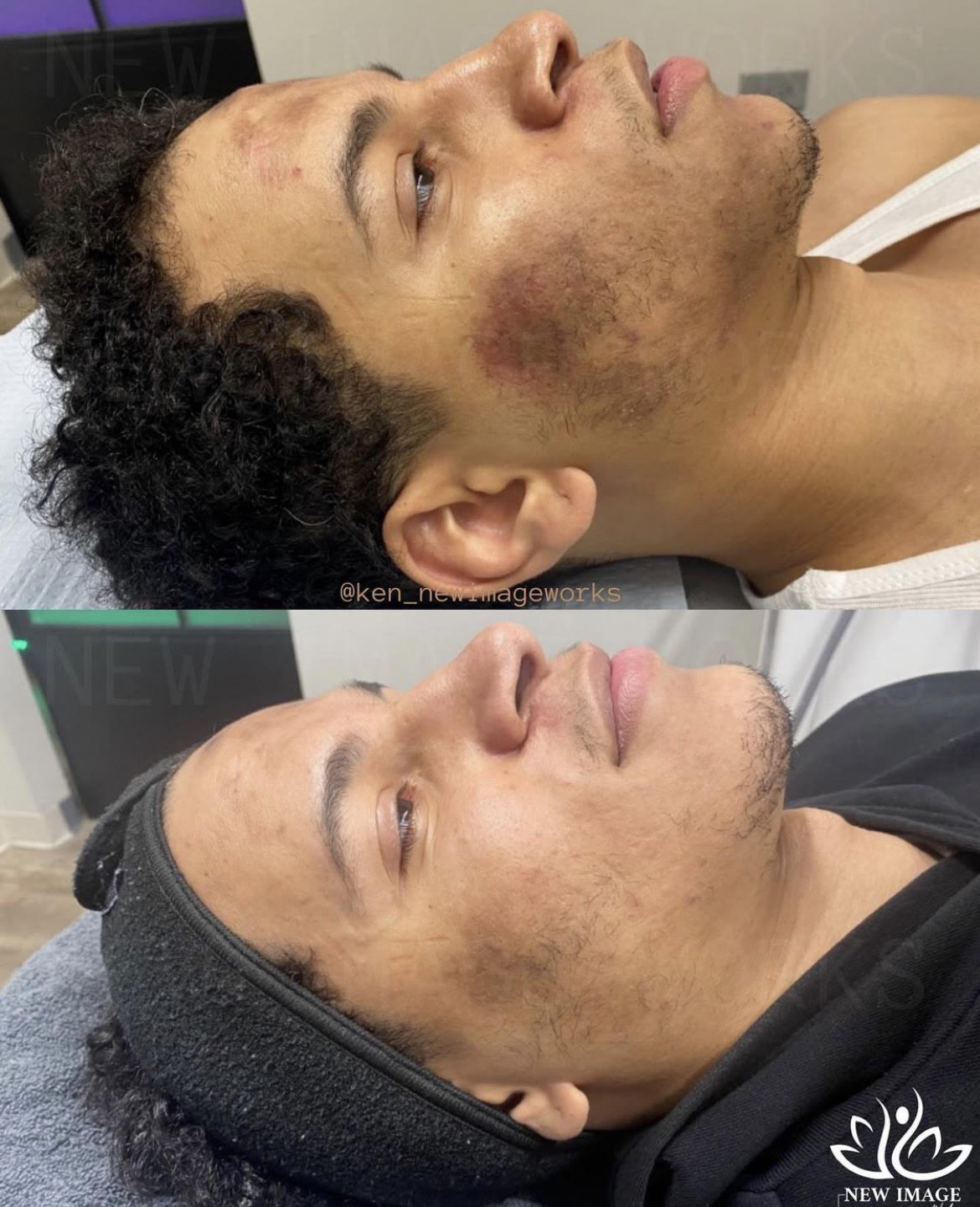 Refine Me (3 Moxi + 3 Microneedling Treatments)