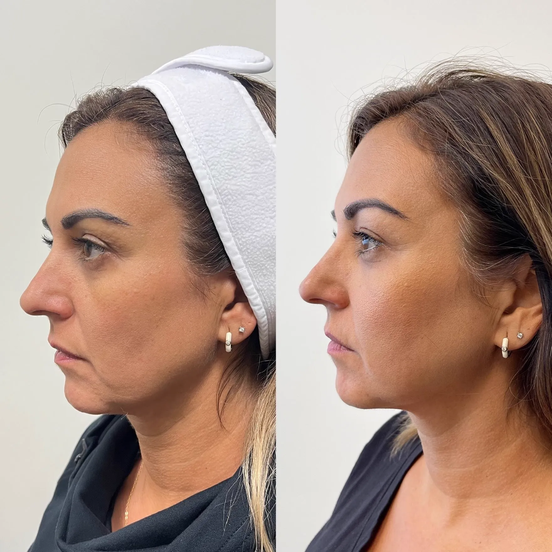 Sylfirm X Fractional RF 2 Area 3 Sessions
